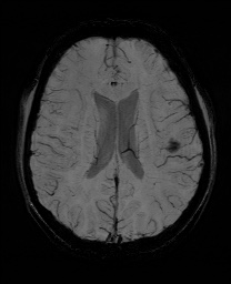Cerebral cavernous venous malformation (Radiopaedia 70008-80021 Axial SWI 43).jpg