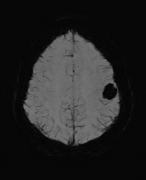 Cerebral cavernous venous malformation (Radiopaedia 70008-80021 Axial SWI 52).jpg