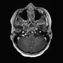 Cerebral cavernous venous malformation (Radiopaedia 70008-80021 Axial T1 C+ 12).jpg