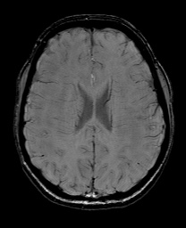 Cerebral cavernous venous malformation (Radiopaedia 70008-80021 I 47).jpg