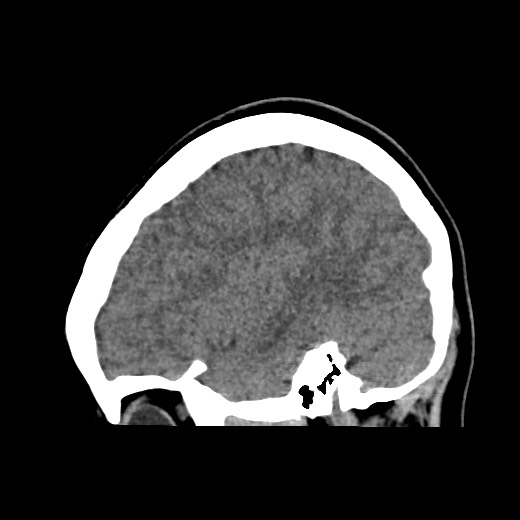 File:Cerebral cavernous venous malformation (Radiopaedia 70008-80022 C 43).jpg