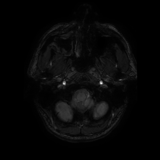 Cerebral cavernous venous malformation (Zabramski type II) (Radiopaedia 85511-101198 Axial SWI 14).jpg