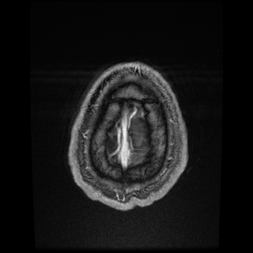 Cerebral cavernous venous malformation (Zabramski type II) (Radiopaedia 85511-101198 Axial T1 C+ fat sat 12).jpg