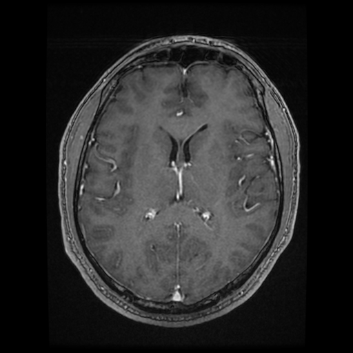 Cerebral cavernous venous malformation (Zabramski type II) (Radiopaedia 85511-101198 Axial T1 C+ fat sat 40).jpg