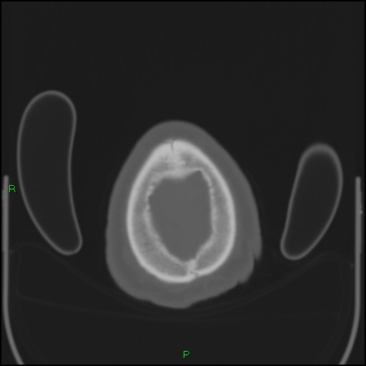 Cerebral contusions (Radiopaedia 33868-35039 Axial bone window 212).jpg