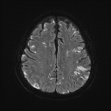 Cerebral embolic infarcts (embolic shower) (Radiopaedia 72391-82921 Axial DWI 51).jpg