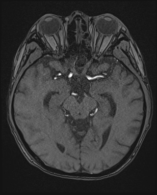 Cerebral embolic infarcts (embolic shower) (Radiopaedia 72391-82921 Axial MRA 66).jpg