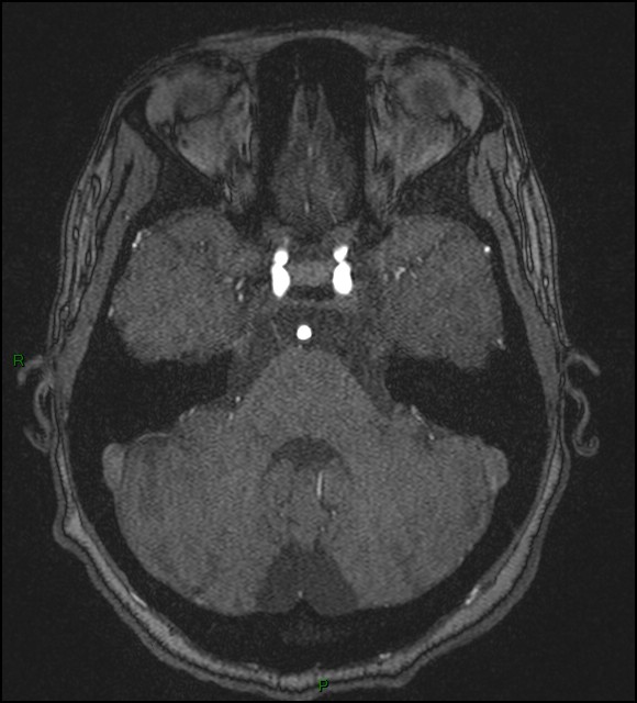 Cerebral fat embolism (Radiopaedia 35022-36525 Axial TOF 54).jpg