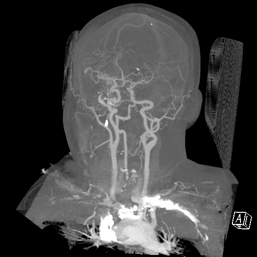 File:Cerebral hemorrhage secondary to arteriovenous malformation (Radiopaedia 33497-34571 A 17).png