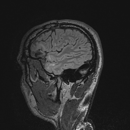 File:Cerebral hemorrhagic contusions- temporal evolution (Radiopaedia 40224-42757 Sagittal T1 67).png