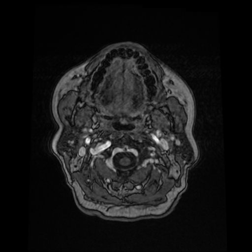 File:Cerebral metastases - melanoma (Radiopaedia 80972-94522 Axial T1 C+ 11).jpg