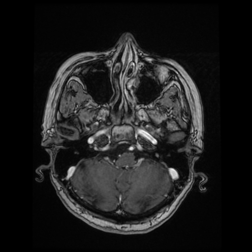 Cerebral metastases - melanoma (Radiopaedia 80972-94522 Axial T1 C+ 33).jpg