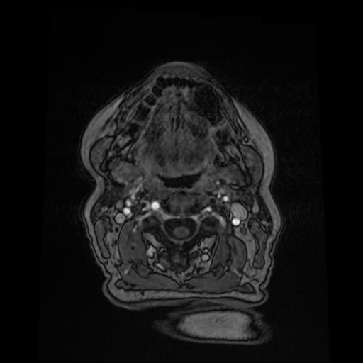 File:Cerebral metastases - melanoma (Radiopaedia 80972-94522 Axial T1 C+ 6).jpg