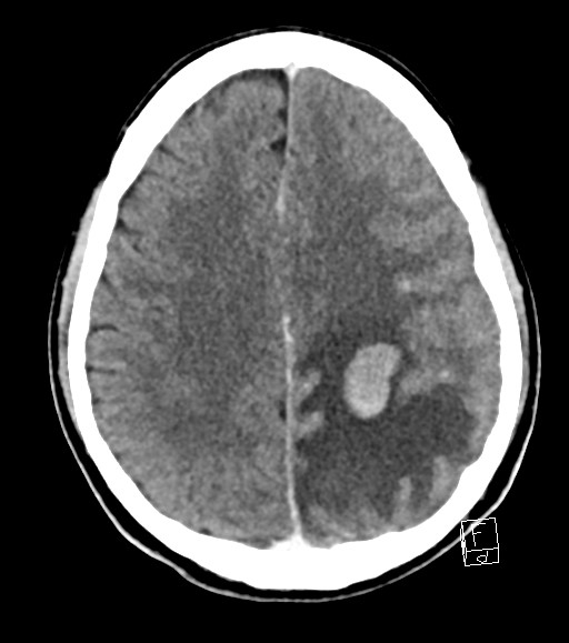 Cerebral metastases - testicular choriocarcinoma (Radiopaedia 84486-99855 Axial C+ delayed 21).jpg