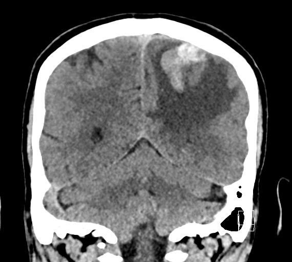 Cerebral metastases - testicular choriocarcinoma (Radiopaedia 84486-99855 Coronal C+ delayed 45).jpg