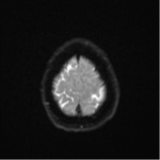 Cerebral metastasis (Radiopaedia 46744-51248 Axial DWI 25).png