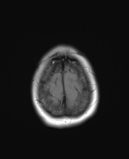 File:Cerebral metastasis (Radiopaedia 46744-51248 Axial T1 26).png