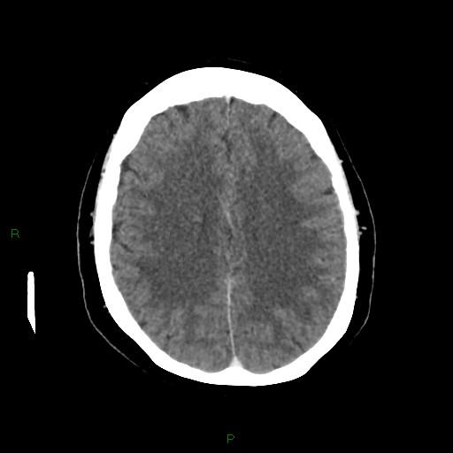 File:Cerebral metastasis from renal cell carcinoma (Radiopaedia 82306-96375 Axial C+ delayed 25).jpg