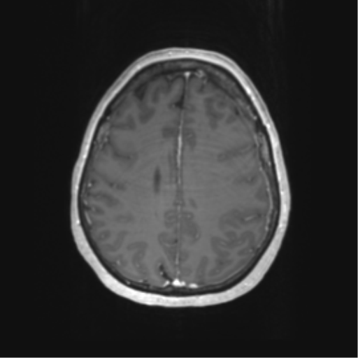 Cerebral metastasis mimicking glioblastoma (Radiopaedia 69155-78937 Axial T1 C+ 49).png