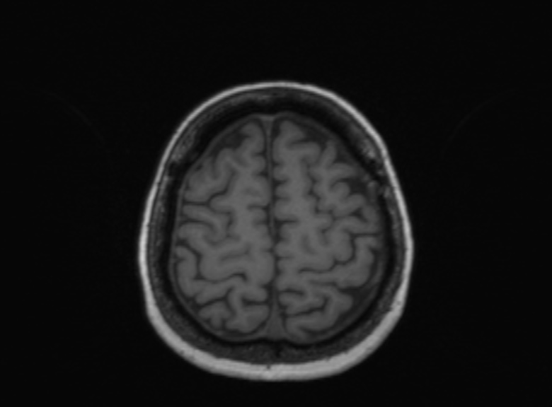 Cerebral ring enhancing lesions - cerebral metastases (Radiopaedia 44922-48817 Axial T1 137).jpg