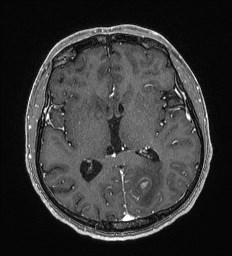 Cerebral toxoplasmosis (Radiopaedia 43956-47461 Axial T1 C+ 37).jpg