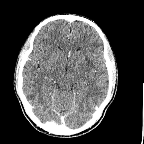 File:Cerebral toxoplasmosis (Radiopaedia 53993-60131 Axial C+ delayed 32).jpg