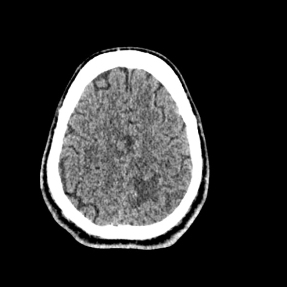 Cerebral toxoplasmosis (Radiopaedia 53993-60131 Axial non-contrast 64).jpg