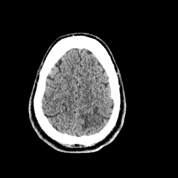 File:Cerebral toxoplasmosis (Radiopaedia 53993-60131 Axial non-contrast 67).jpg
