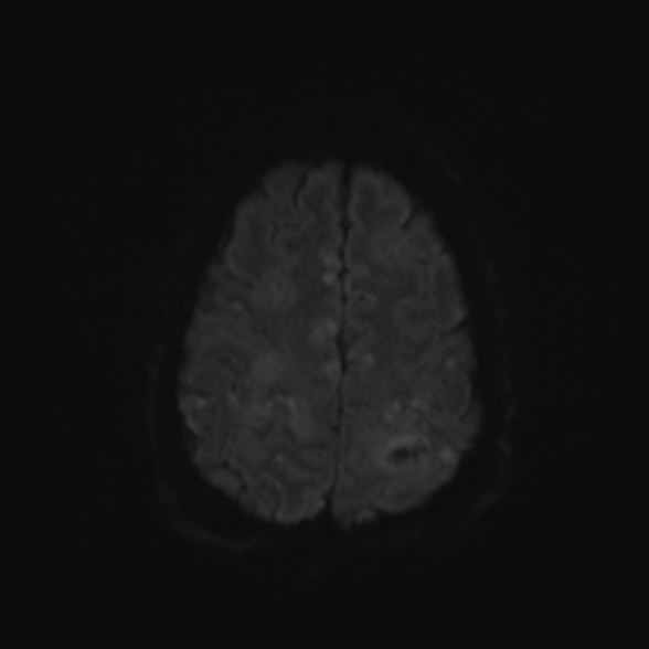 Cerebral toxoplasmosis (Radiopaedia 53993-60132 Axial DWI 49).jpg