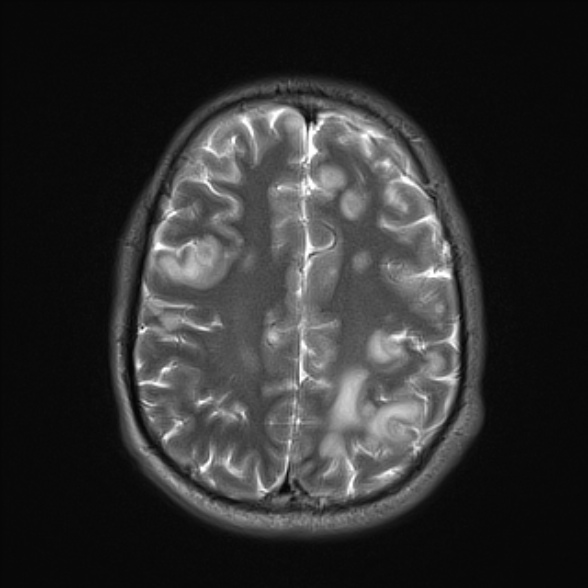 File:Cerebral toxoplasmosis (Radiopaedia 53993-60132 Axial T2 20).jpg