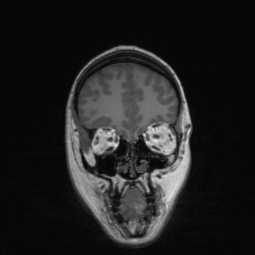 Cerebral tuberculosis with dural sinus invasion (Radiopaedia 60353-68090 Coronal T1 46).jpg