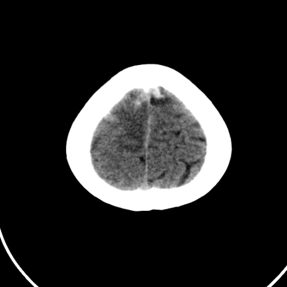File:Cerebral venous hemorrhagic infarct from venous sinus thrombosis (Radiopaedia 55433-61879 Axial non-contrast 23).jpg