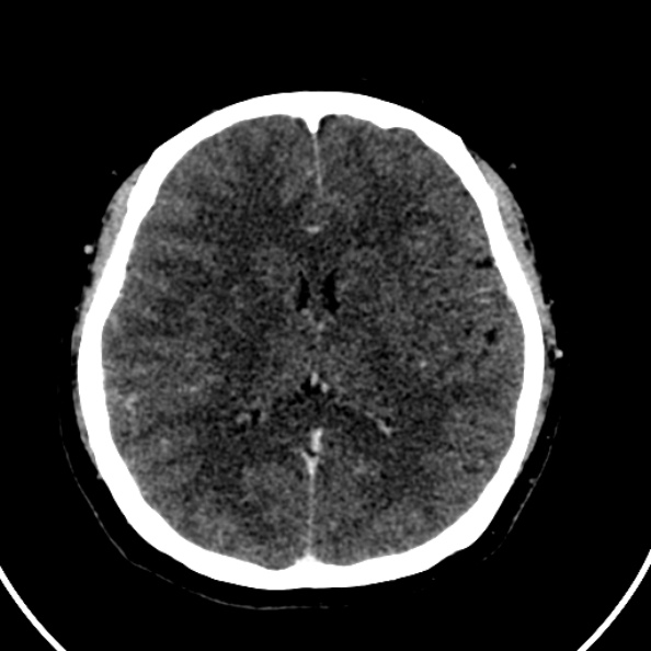 Cerebral venous hemorrhagic infarct from venous sinus thrombosis (Radiopaedia 55433-61883 Axial C+ delayed 70).jpg