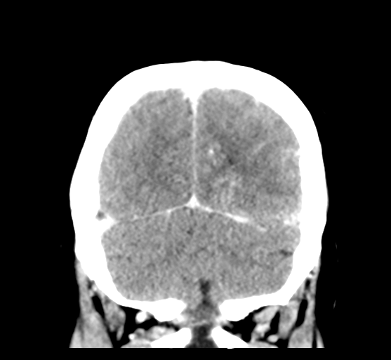 File:Cerebral venous hemorrhagic infarction (Radiopaedia 57576-64538 Coronal C+ 50).png