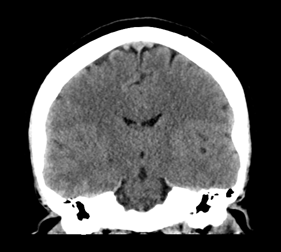 File:Cerebral venous infarct related to dural venous sinus thromboses (Radiopaedia 35292-36804 Coronal non-contrast 19).png