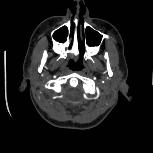 Cerebral venous sinus thrombosis (Radiopaedia 40619-43227 A 10).jpg