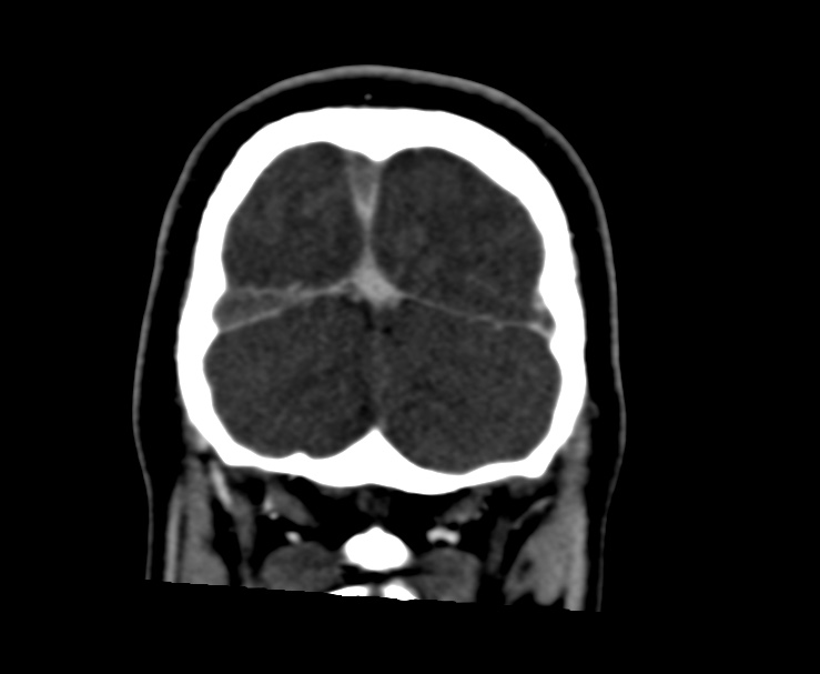 Cerebral venous sinus thrombosis (Radiopaedia 59224-66646 Coronal C+ delayed 69).jpg