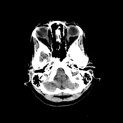 Cerebral venous throbmosis - hemorrhagic venous infarction (Radiopaedia 87318-103613 Axial non-contrast 27).jpg