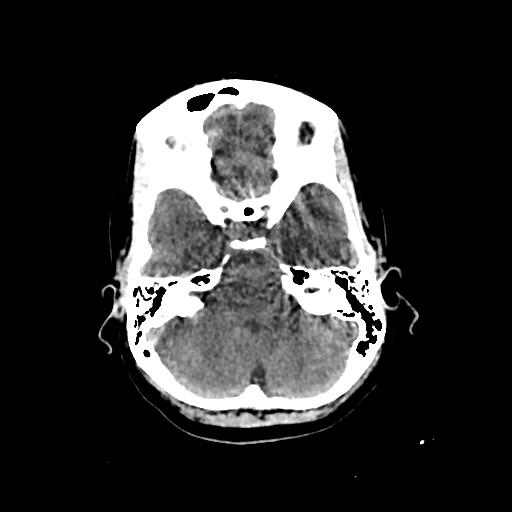 Cerebral venous throbmosis - hemorrhagic venous infarction (Radiopaedia 87318-103613 Axial non-contrast 40).jpg