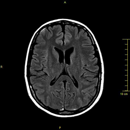 File:Cerebral venous thrombosis (Radiopaedia 23288-23351 Axial FLAIR 11).JPG