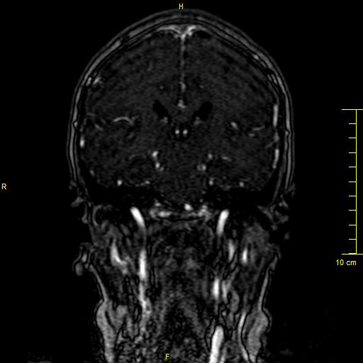 Cerebral venous thrombosis (Radiopaedia 23288-23351 MRV 87).JPG