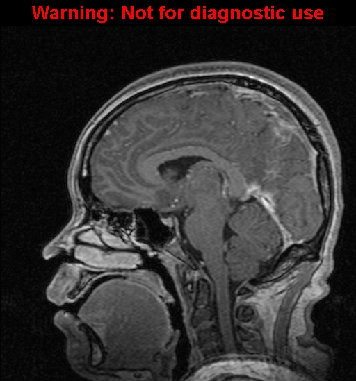 Cerebral venous thrombosis (Radiopaedia 37224-39208 Sagittal T1 C+ 80).jpg