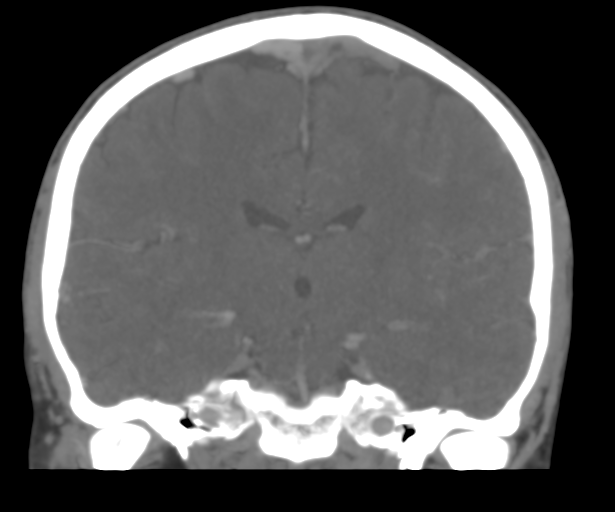 Cerebral venous thrombosis (Radiopaedia 38392-40467 Coronal CTA-Venogram 34).png