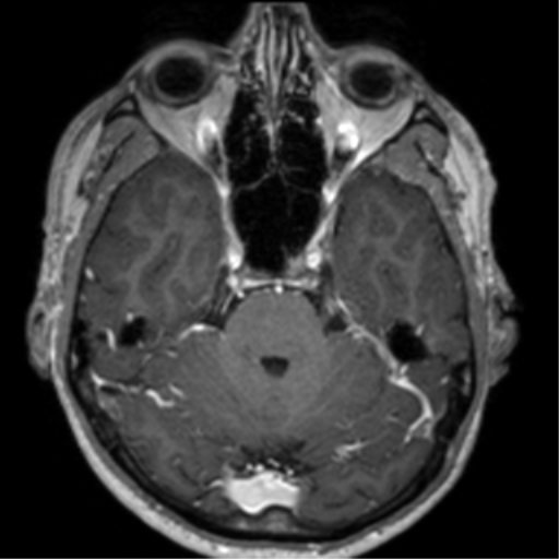 Cerebral venous thrombosis (Radiopaedia 38392-40469 Axial T1 C+ 26).png