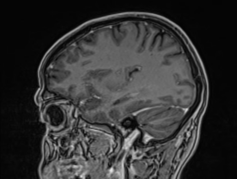 Cerebral venous thrombosis (Radiopaedia 71207-81504 Sagittal T1 C+ 46).jpg
