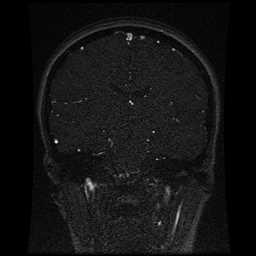 Cerebral venous thrombosis - ulcerative colitis (Radiopaedia 66049-75219 Coronal MRV 57).jpg