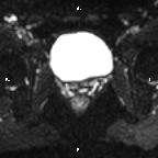 File:Cervical adenocarcinoma (Radiopaedia 65011-73985 Axial DWI 31).jpg