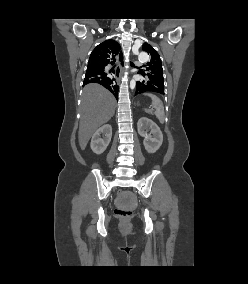 Cervical aortic arch with coarctation and aneurysms (Radiopaedia 44035-47552 C 16).jpg