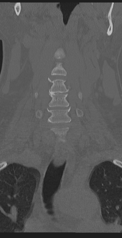 Cervical canal stenosis due to ossification of the posterior longitudinal ligament (Radiopaedia 47260-51823 Coronal bone window 13).png