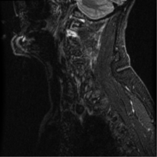 File:Cervical canal stenosis with cord compression (Radiopaedia 34114-35374 Sagittal STIR 14).png